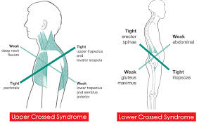 Janda Upper and lower crossed SYNDROME