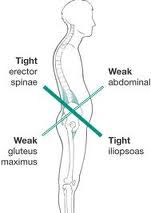 Janda Lower Crossed Syndrome