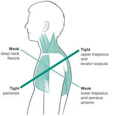 Janda Upper Crossed Syndrome